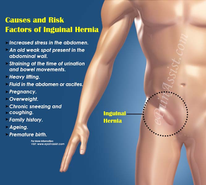 Inguinal Hernia: Symptoms, Risk factors & Surgery