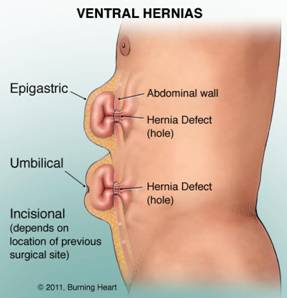 How We Describe a Hernia  Center for Hernia Repair